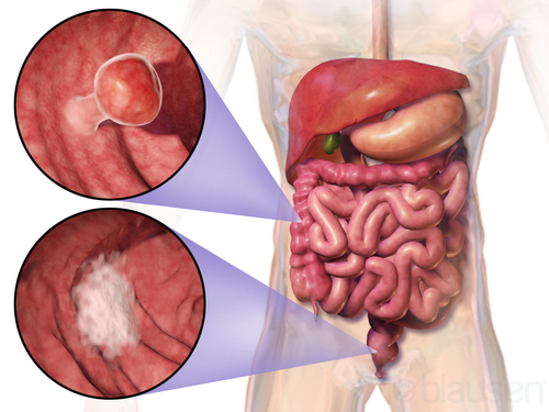 Colon cancer
